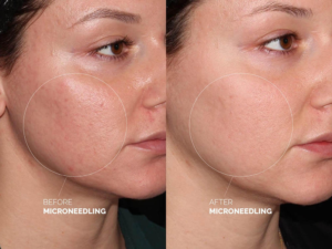 Microneedling PRP NYC: The Ultimate Skin Rejuvenation Treatment