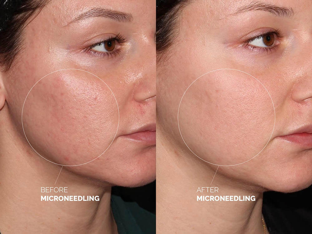Microneedling PRP NYC: The Ultimate Skin Rejuvenation Treatment