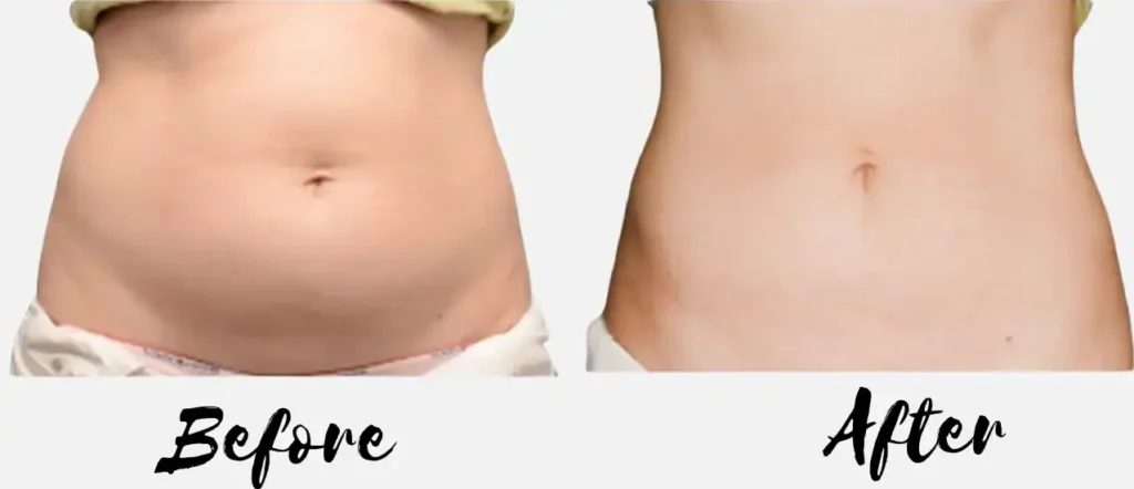 liposuction before and after