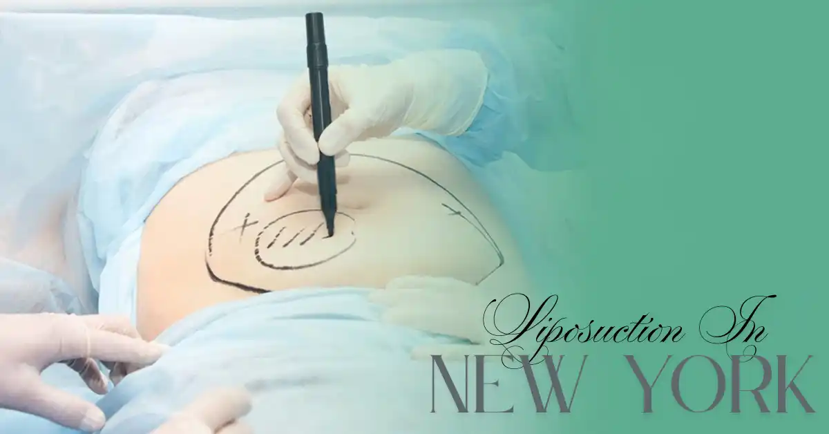 liposuction new york