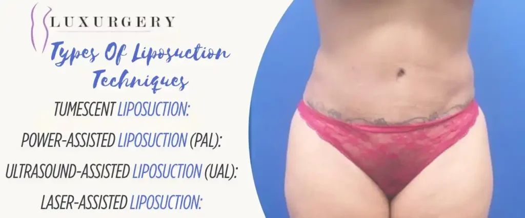 liposuction new york