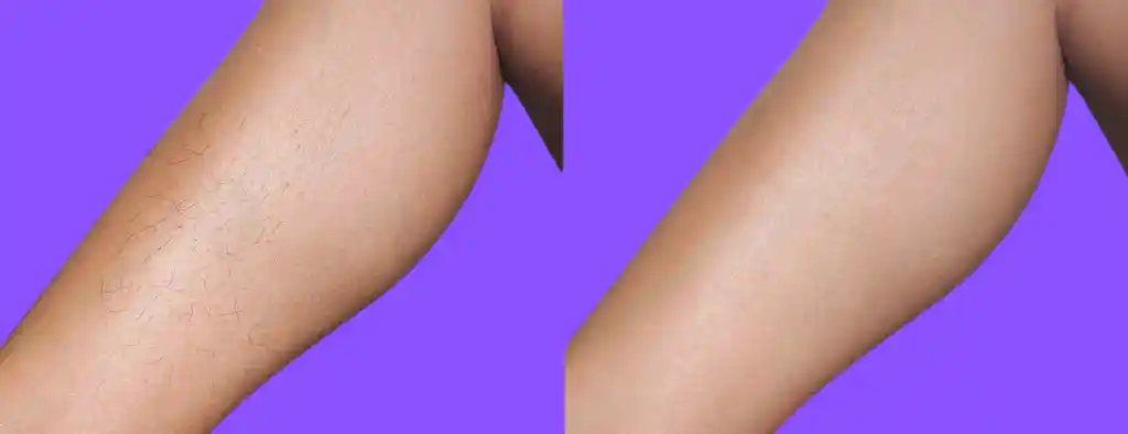 laser hair removal west palm beach