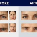 Botox