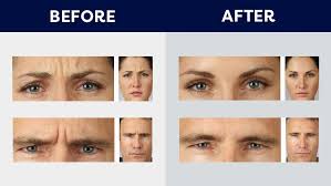 Botox