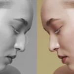 closed rhinoplasty