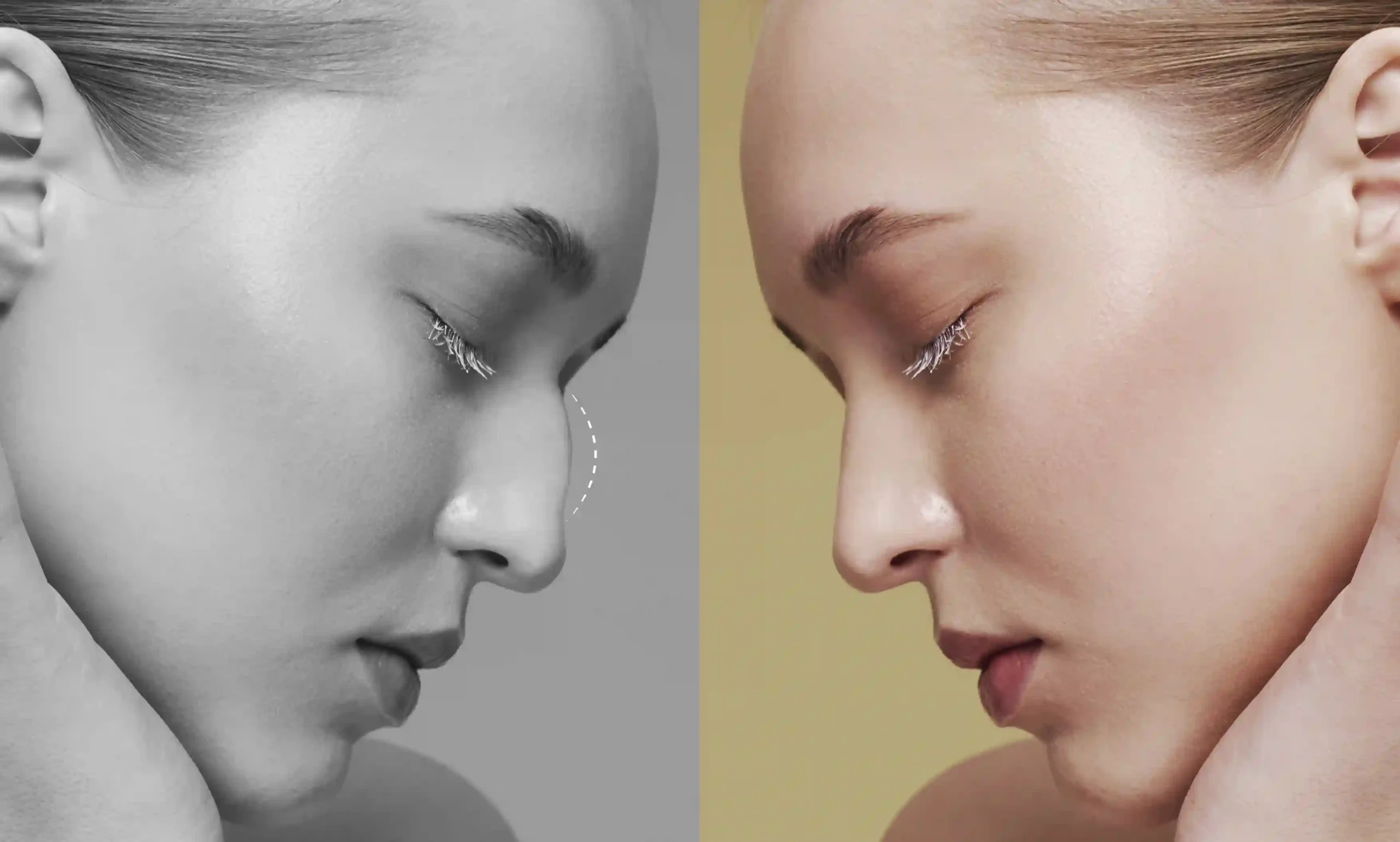 closed rhinoplasty